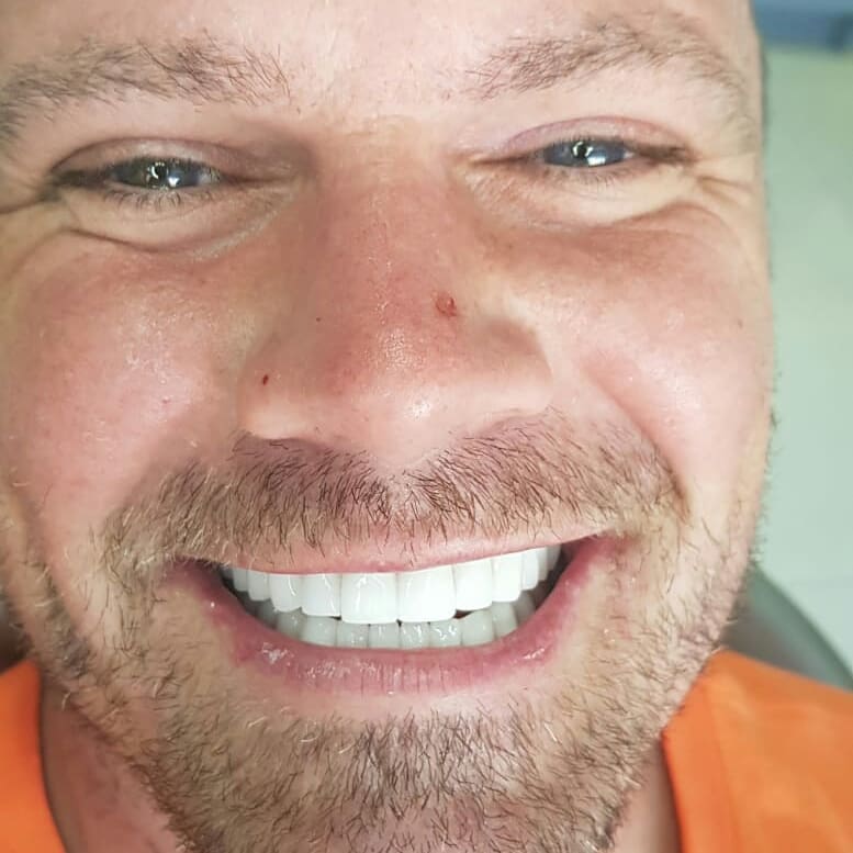 Another amazing makeover to give him a perfect smile, he has always wanted...Contact us today fo